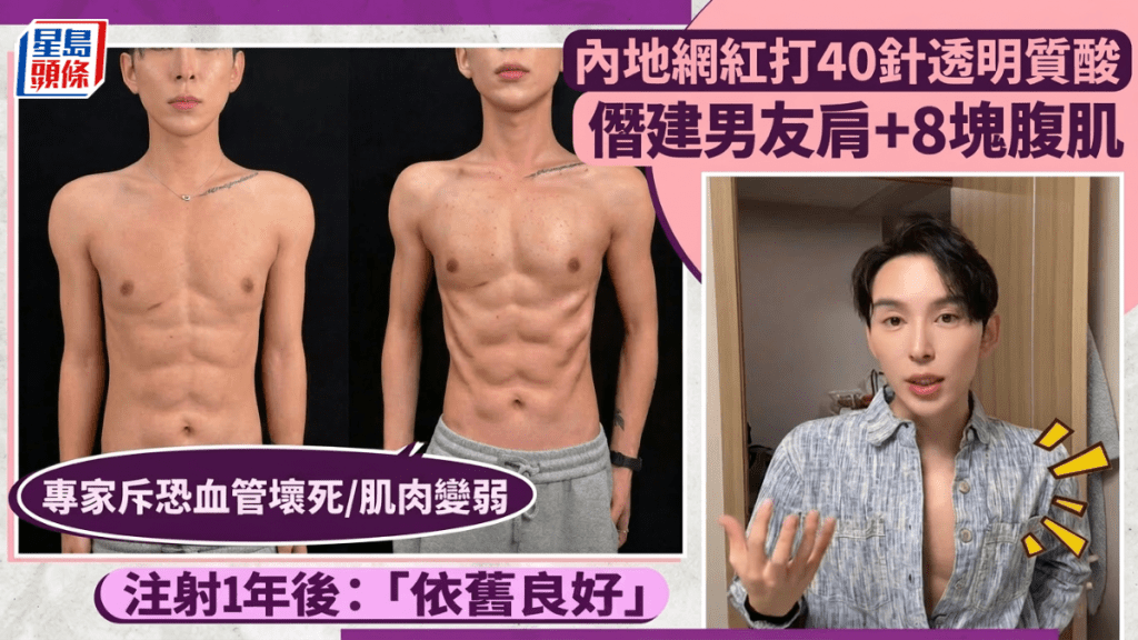 內地網紅打40針透明質酸 「僭建」男友肩+8塊腹肌  專家斥恐血管壞死/肌肉變弱  注射1年後：「依舊良好」