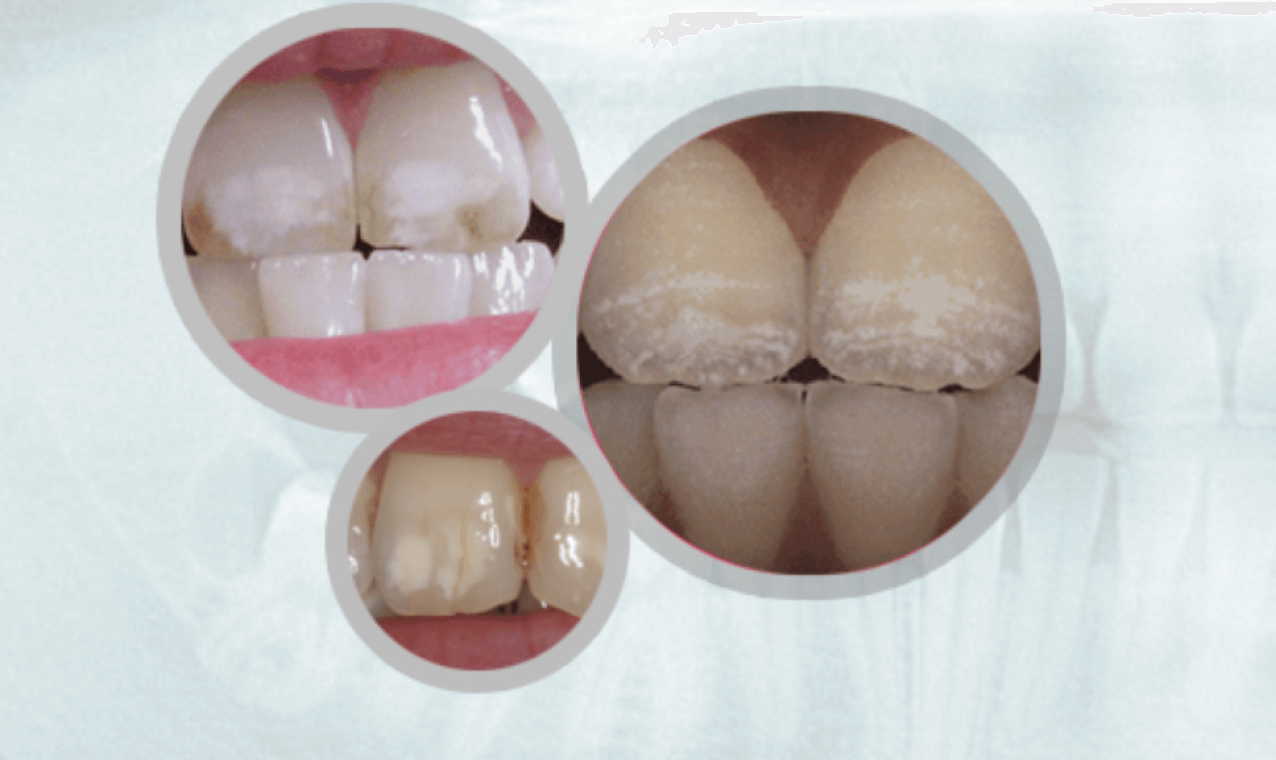 Stages of Fluorosis Composition
