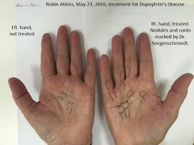Dupuytren's disease, markup of nodules and cords on both hands Dupuytren's disease, markup of nodules and cords on both hands