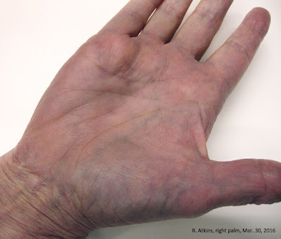 Dupuytrens Disease, stage N, my right hand Dupuytrens Disease, stage N, my right hand