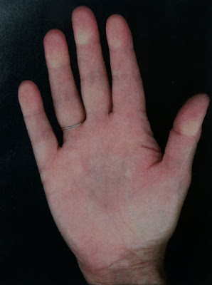 Dupuytrens Disease, my right hand prior to symptoms showing Dupuytrens Disease, my right hand prior to symptoms showing