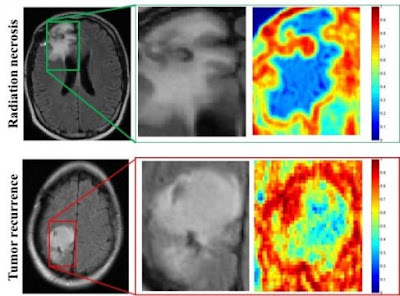 MRI Scans Of Patients With Radiation Necrosis MRI Scans Of Patients With Radiation Necrosis