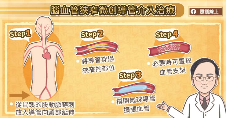 血管狹窄中風