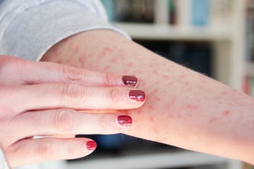 Skin rash Skin rash