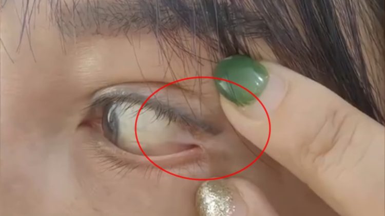 Woman’s Eyeball Sewn to the Corner of Her Eye in Botched Cosmetic Surgery